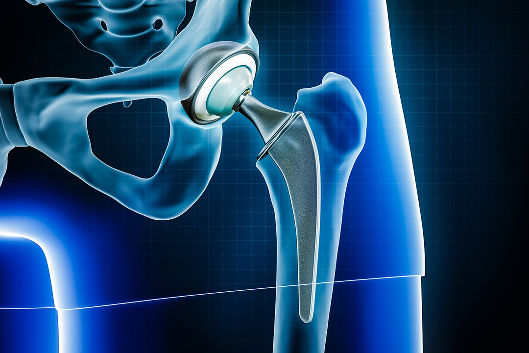 Hip Replacement Surgery (Total Hip Arthroplasty)