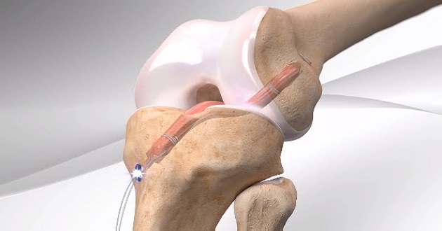 Anterior cruciate ligament reconstruction – ACL
