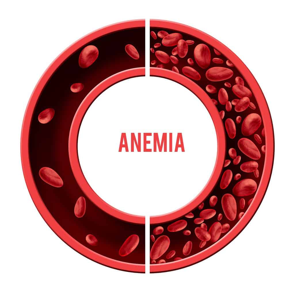 anemia treatment anemia treatment