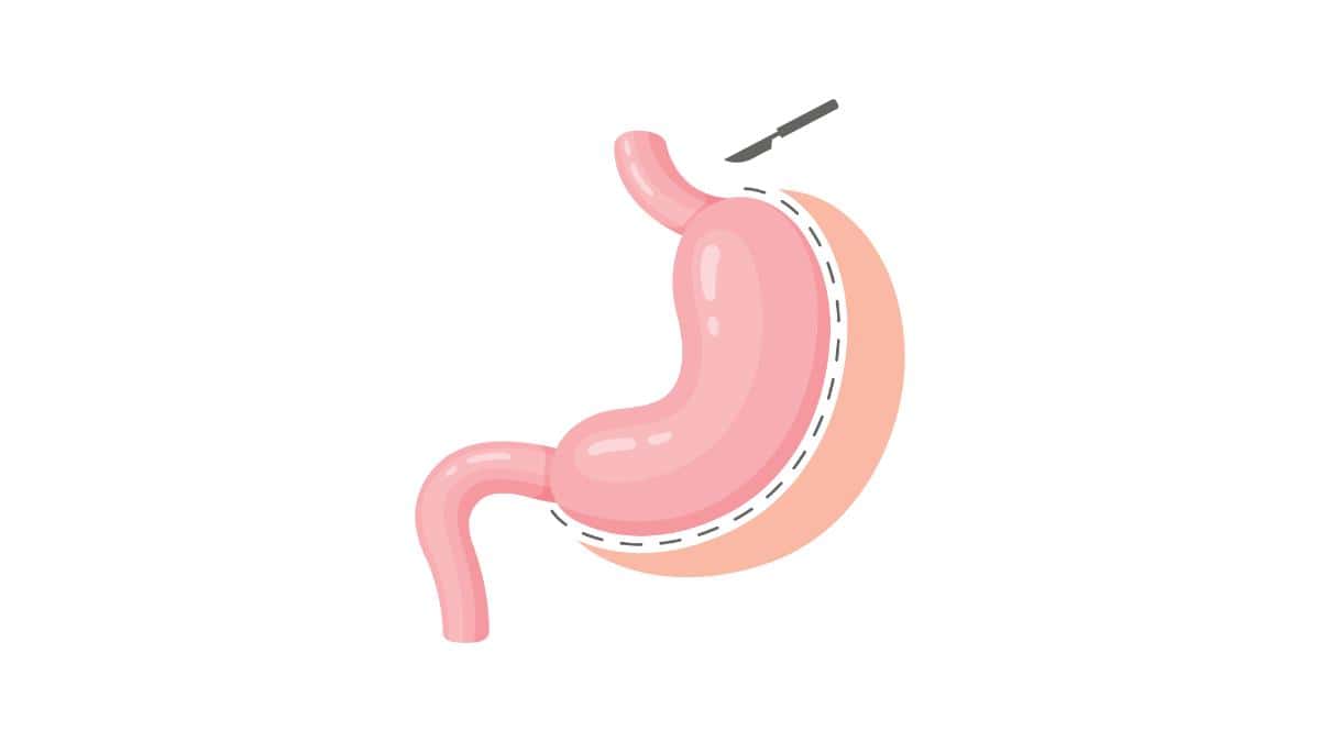 3 reasons why bariatric surgery is not suitable for three-day medical tourism