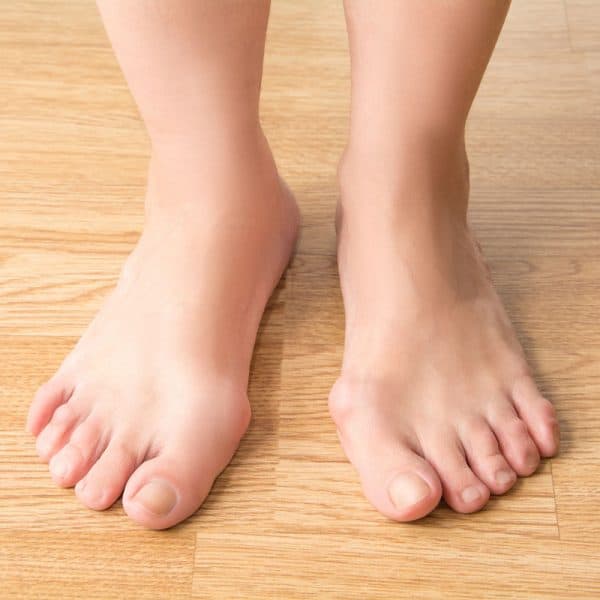 bunions on feet bunions on feet