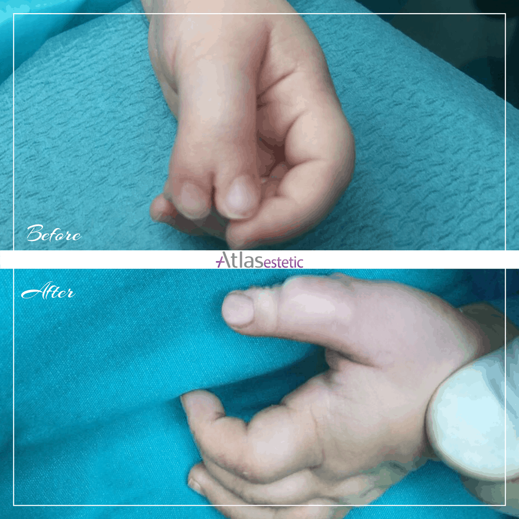 before and after polydactyly before and after polydactyly