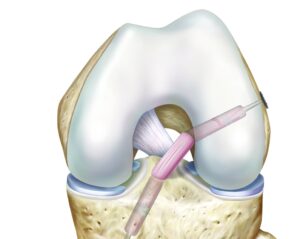 Anterior cruciate ligament reconstruction - ACL Anterior cruciate ligament reconstruction - ACL