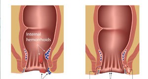 hemorrhoids