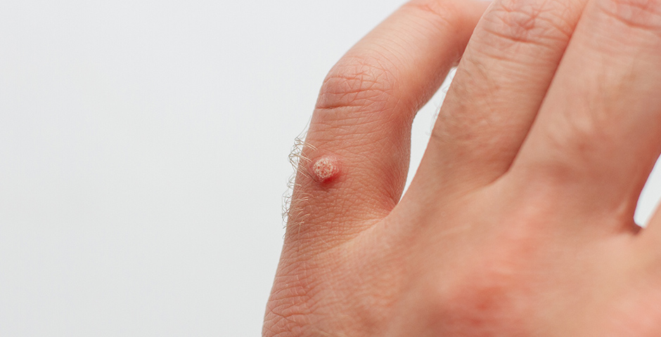 lice Warts