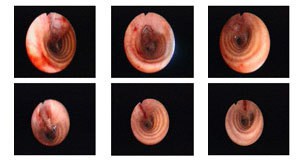 Bronchoscopy