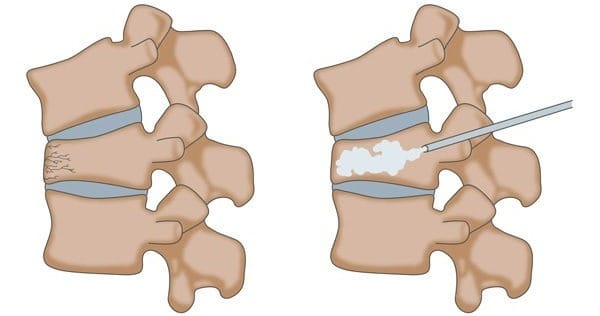 vertebroplasty for the vertebrae vertebroplasty for the vertebrae