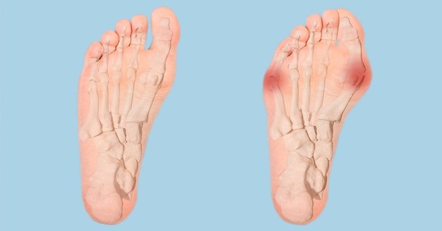 Bunion surgery – hallux valgus
