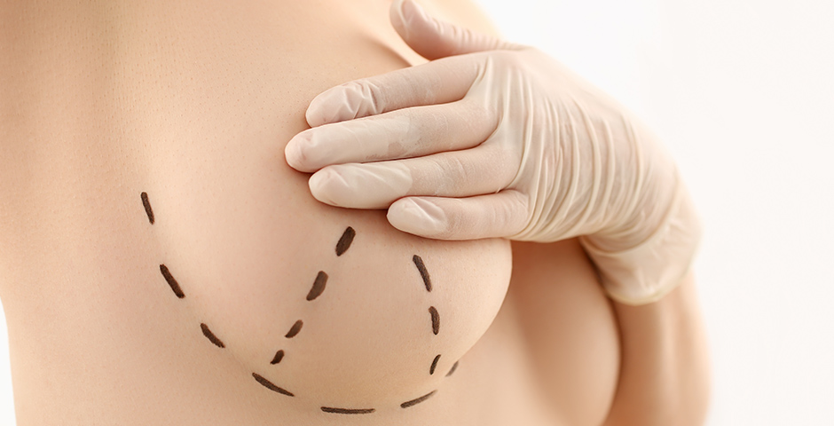 Breast lift surgery