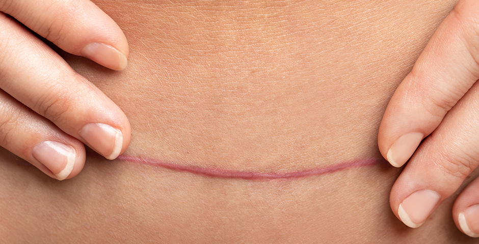 lice Scar correction