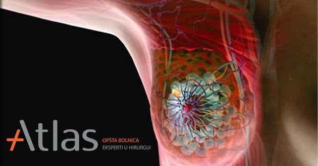 Breast cancer-causes, symptoms and treatment