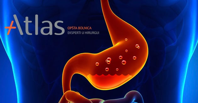 Gastroesophageal reflux disease GERD