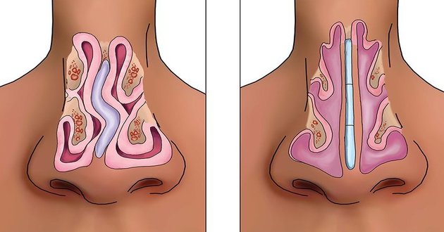 Surgery of the nasal septum – Septoplasty