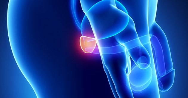 Karcinom prostate treba prepoznati na vreme!